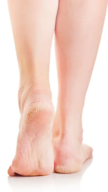 ઠંડી-ગરમી નહીં, એડીઓ ફાટવા માટે જવાબદાર છે આ 3 પોષક તત્ત્વો! જાણો કયા વિટામિનની છે ઊણપ